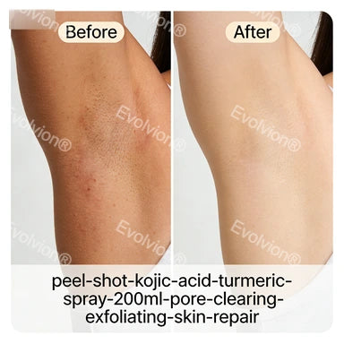 Evolvion®Peel Shot Kojic Acid & Turmeric Spray 200ml - Pore Clearing, Exfoliating & Skin Repair