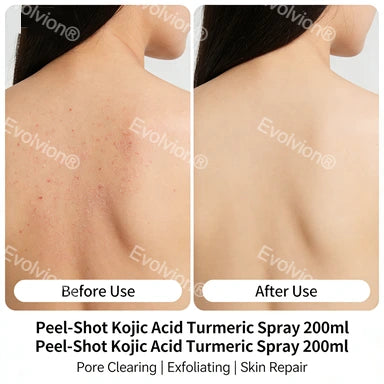 Evolvion®Peel Shot Kojic Acid & Turmeric Spray 200ml - Pore Clearing, Exfoliating & Skin Repair