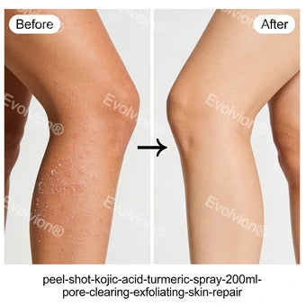Evolvion®Peel Shot Kojic Acid & Turmeric Spray 200ml - Pore Clearing, Exfoliating & Skin Repair