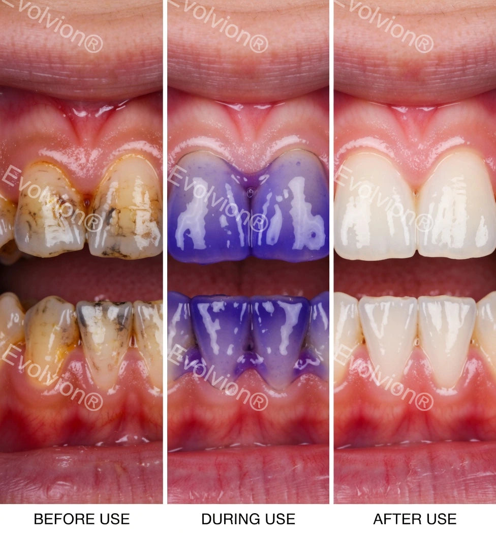 Evolvion®Purple Teeth Whitening Strips