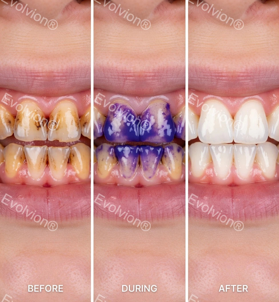 Evolvion®Purple Teeth Whitening Strips