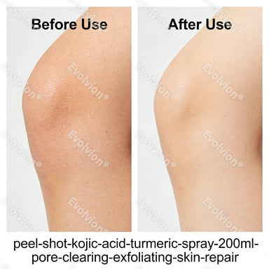 Evolvion®Peel Shot Kojic Acid & Turmeric Spray 200ml - Pore Clearing, Exfoliating & Skin Repair